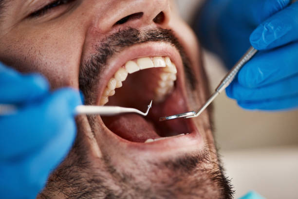 Best Urgent Tooth Repair  in Silver Springs, FL